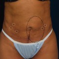 Is smart lipo permanent?