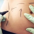 Tumescent Liposuction: The Non-Surgical Way to a Better Body