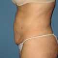 Which is better, coolsculpting or smartlipo?