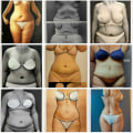 What happens if you gain weight after lipo 360?