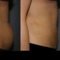 Does smart lipo leave loose skin?