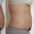 Does laser lipo cause sagging skin?