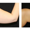 Which is more effective liposuction or coolsculpting?