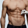 Laser-Assisted Liposuction (LAL): A Safe and Effective Alternative to Traditional Liposuction