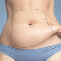 Can coolsculpting fix bad liposuction?