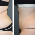 Maximizing Your Results: Traditional Liposuction Explained