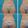 Is smartlipo better than liposuction?