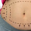 How long after smart liposuction will i see results?