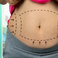 Understanding Wet Liposuction: A Comprehensive Guide to Non-Surgical Fat Reduction