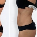 Dry Liposuction: A Non-Surgical Way to Achieve Your Dream Body