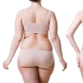 Benefits of Liposuction: A Patient's Perspective