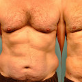 Achieving Gradual and Natural-Looking Results with Smart Lipo