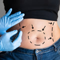 Suction-Assisted Liposuction (SAL): Your Guide to Non-Surgical Fat Reduction