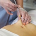 Understanding Injection Lipolysis: A Non-Surgical Alternative to Smart Lipo