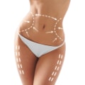 Do you lose weight with smart liposuction?