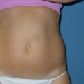 How long does it take for smart lipo to work?