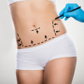 Boosting Self-Confidence: How Smart Lipo Can Help You Achieve Your Dream Body