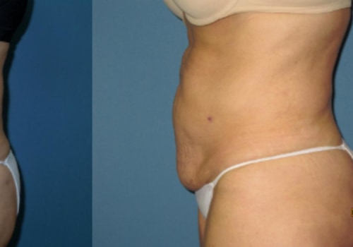 Which is better, coolsculpting or smartlipo?