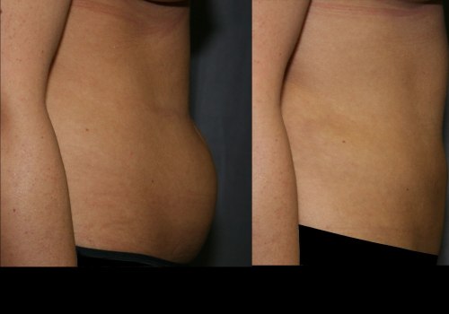 Does smart lipo leave loose skin?