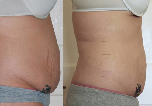 Does laser lipo cause sagging skin?