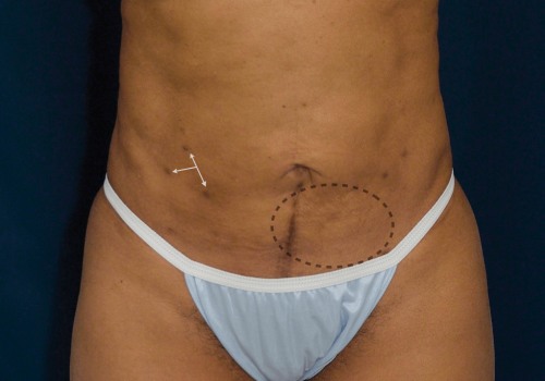 What's the difference between smart lipo and regular liposuction?