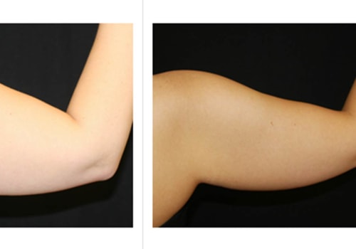 Which is more effective liposuction or coolsculpting?