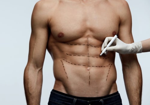 Laser-Assisted Liposuction (LAL): A Safe and Effective Alternative to Traditional Liposuction