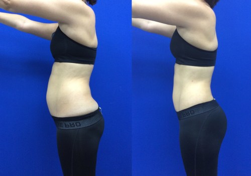 How expensive is smart liposuction?