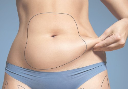 Can coolsculpting fix bad liposuction?