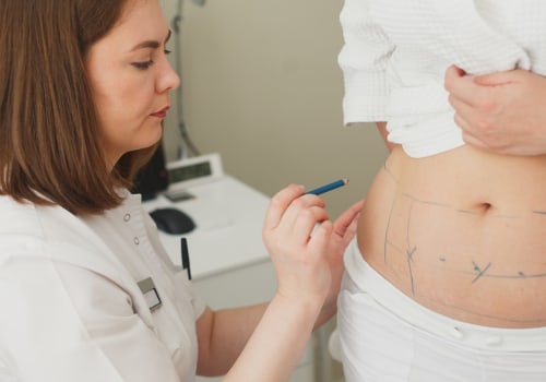 Understanding the Risks and Benefits of Liposuction: A Comprehensive Guide