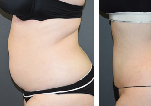 Maximizing Your Results: Traditional Liposuction Explained