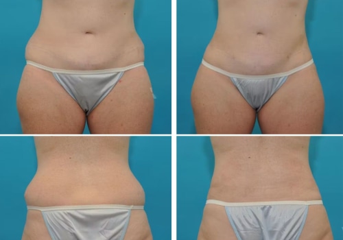 Is smartlipo better than liposuction?