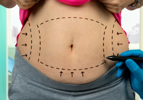 Understanding Wet Liposuction: A Comprehensive Guide to Non-Surgical Fat Reduction