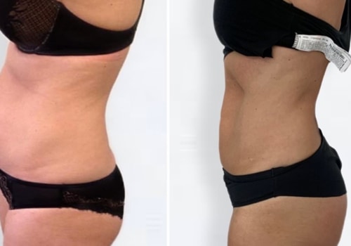 Dry Liposuction: A Non-Surgical Way to Achieve Your Dream Body