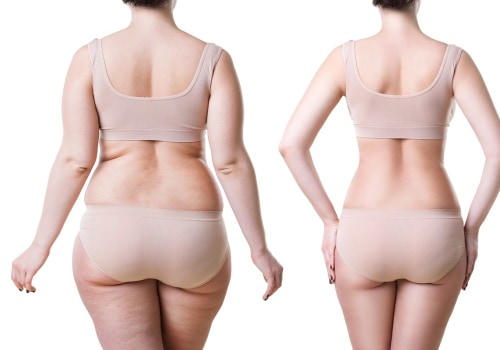 Benefits of Liposuction: A Patient's Perspective