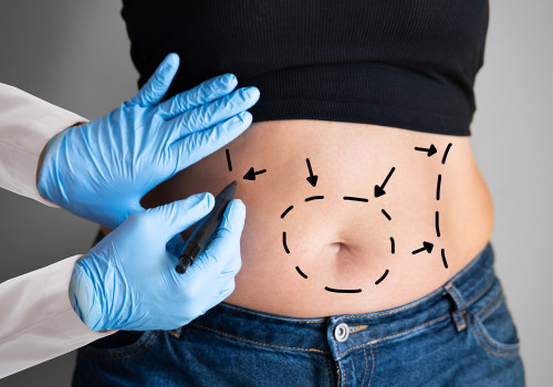 Suction-Assisted Liposuction (SAL): Your Guide to Non-Surgical Fat Reduction