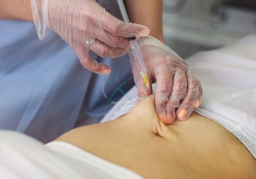 Understanding Injection Lipolysis: A Non-Surgical Alternative to Smart Lipo