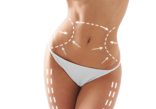 Do you lose weight with smart liposuction?