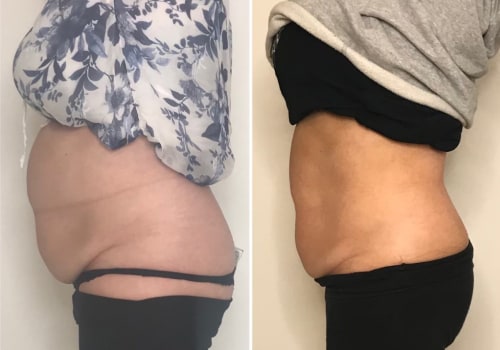 Liposuction Alternatives: A Comprehensive Look at Smart Lipo and Other Options