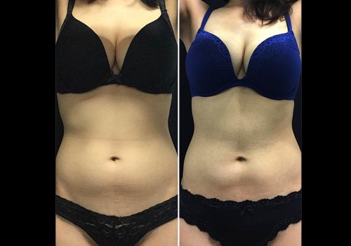 Everything You Need to Know About CoolLipo