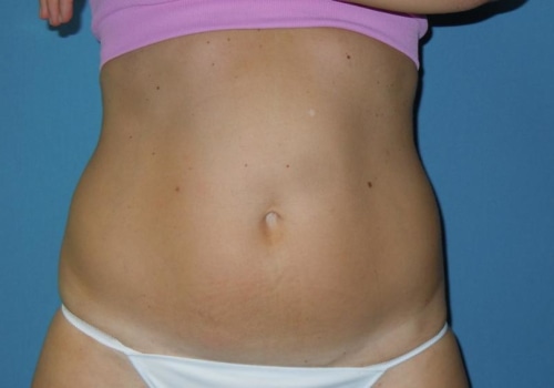 How long does it take for smart lipo to work?