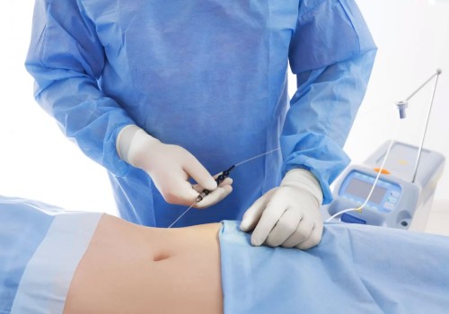 Does smart lipo really work?