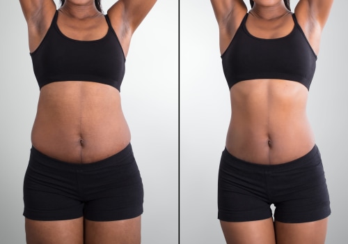 LipoDissolve: The Non-Surgical Solution for a Slimmer You